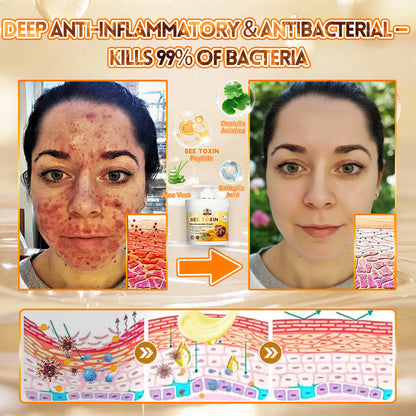 🐝🔥FDA Approved|Cheemex® Bee Venom Skin Restoration Cream (Anti-aging, Hydrating, Skin Repair, Even Tone, Acne and Dark Spot Treatment, Wart and Mole Removal, Psoriasis Relief)