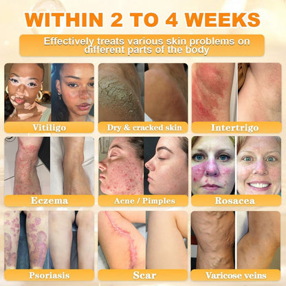 🐝🔥FDA Approved|Cheemex® Bee Venom Skin Restoration Cream (Anti-aging, Hydrating, Skin Repair, Even Tone, Acne and Dark Spot Treatment, Wart and Mole Removal, Psoriasis Relief)