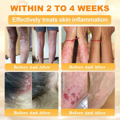 🐝🔥FDA Approved|Cheemex® Bee Venom Skin Restoration Cream (Anti-aging, Hydrating, Skin Repair, Even Tone, Acne and Dark Spot Treatment, Wart and Mole Removal, Psoriasis Relief)