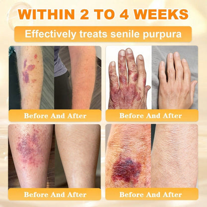 🐝🔥FDA Approved|Cheemex® Bee Venom Skin Restoration Cream (Anti-aging, Hydrating, Skin Repair, Even Tone, Acne and Dark Spot Treatment, Wart and Mole Removal, Psoriasis Relief)