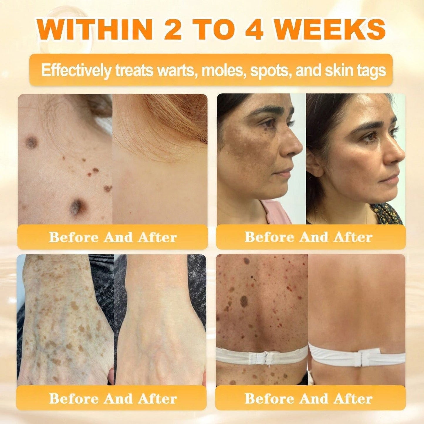 🐝🔥FDA Approved|Cheemex® Bee Venom Skin Restoration Cream (Anti-aging, Hydrating, Skin Repair, Even Tone, Acne and Dark Spot Treatment, Wart and Mole Removal, Psoriasis Relief)